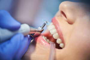 Dental Cleanings Lafayette